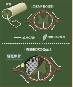 脊髄梗塞の画像